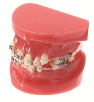 Dentistry Model-Orthodontic Tooth Model Half Ceramic Half Metal Bracket with Anchor Nail-Sciedu(CM):8x7x6 | ABC Books