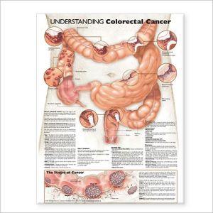 Understanding Colorectal Cancer Chart | ABC Books