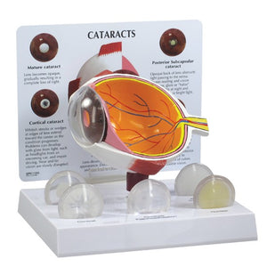 Eye Model-Cataract Eye- GPI-Size(CM): 17x14x13 | ABC Books