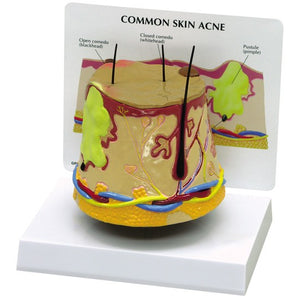 Skin Model-Skin Acne- GPI (CM): 16x12x13 | ABC Books