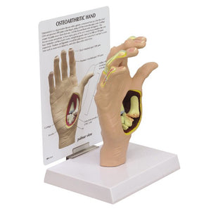 Hand Model-Osteoarthritis Hand-GPI (CM): 21x16x12 | ABC Books