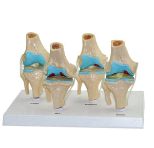 Bone Model- Model of Pathology Knee- 4 Pieces-Sciedu (CM): 27x17x16 | ABC Books