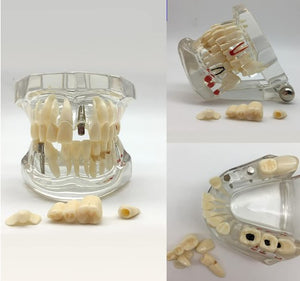 Dentistry Model-Pathology Model with Implant with Nerves- Sciedu(CM):10x8x6 CM | ABC Books