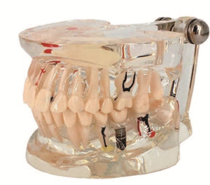 Dentistry Model-Adult Pathological Implant Tooth Model-Sciedu(CM):10x7x6 | ABC Books