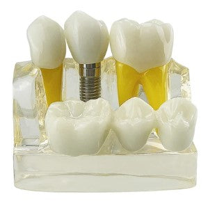 Dentistry Model-Transparent Quadruple Implant Dental Model-Sciedu(CM):10x9x7