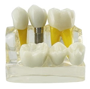 Dentistry Model-Transparent Quadruple Implant Dental Model-Sciedu(CM):10x9x7 | ABC Books