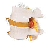 Bone Model-2 Human Lumbar Vertebrae with Prolapsed Disc, Flexibly Mounted- 3B-Size(CM): 8x8x7 | ABC Books