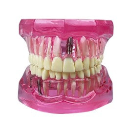 Dentistry Model-Pathology Model with Implant-Sciedu(CM):10x8x6 | ABC Books