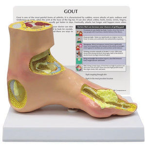 Rheumatology Model-Gout-Foot-GPI (CM): 23x18x18 | ABC Books