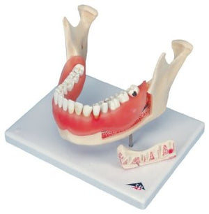 Dentistry Model-Dental Disease Model, Magnified 2 Times, 21 Parts-3B(CM):26x19x18 | ABC Books