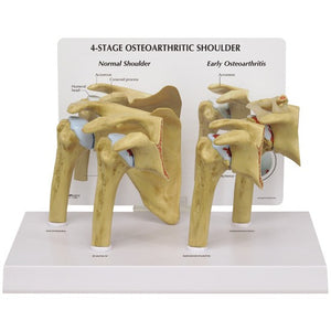 Bone Model-4- Stage Osteoarthritis (OA) Shoulder- GPI(CM):27x16x15 | ABC Books