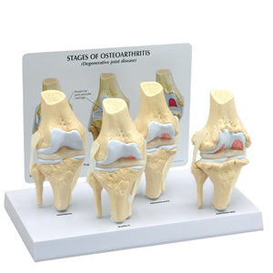 Bone Model-4- Stage Osteoarthritic Knee- GPI (CM): 27x17x16 | ABC Books