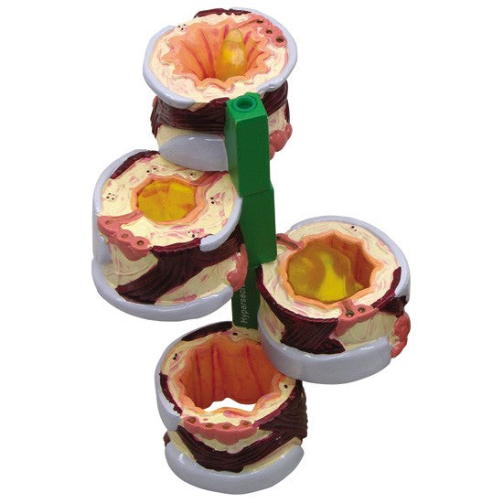 Thoracic Model-4-Pc Bronchus-Stages of Constriction-GPI-Size(CM): 11x9x6