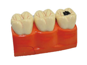 Dentistry Model-Model of Decayed Teeth-Sciedu(CM):13x7x6 | ABC Books