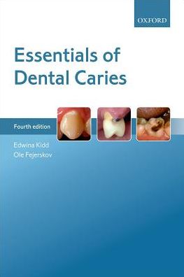 Essentials of Dental Caries, 4e