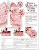 Chronic Obstructive Pulmonary Disease Anatomical Chart, 2e | ABC Books