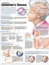 Understanding Alzheimer's Disease Anatomical Chart, 2e | ABC Books