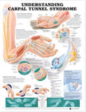 Understanding Carpal Tunnel Syndrome Chart | ABC Books