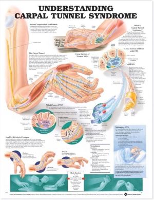 Understanding Carpal Tunnel Syndrome Chart | ABC Books