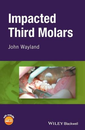 Third Molar Extraction | ABC Books