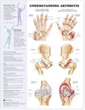Understanding Arthritis Anatomical Chart | ABC Books
