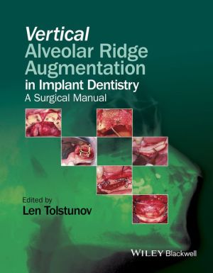 Vertical Alveolar Ridge Augmentation in Implant Dentistry - A Surgical Manual | ABC Books
