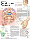 Understanding Parkinson's Disease Anatomical Chart, 2e | ABC Books