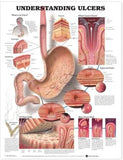 Understanding Ulcers Anatomical Chart | ABC Books