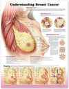 Understanding Breast Cancer Chart, 3e** | ABC Books