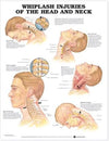 Whiplash Injuries of the Head and Neck Anatomical Chart | ABC Books