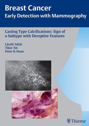 Casting Type Calcifications: Sign of a Subtype with Deceptive Features | ABC Books