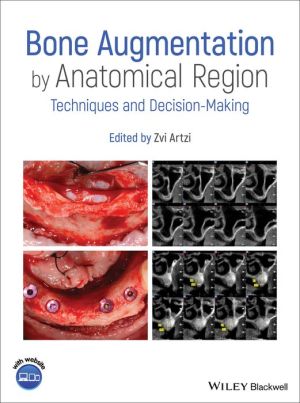 Bone Augmentation by Anatomical Region - Techniques and Decision-Making