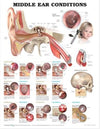 Middle Ear Conditions Chart 2E